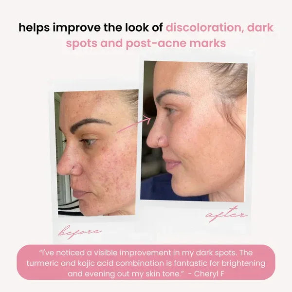 VITA-KOJI™ - Turmeric Kojic Cleansing Pads (80% OFF TODAY ONLY!)